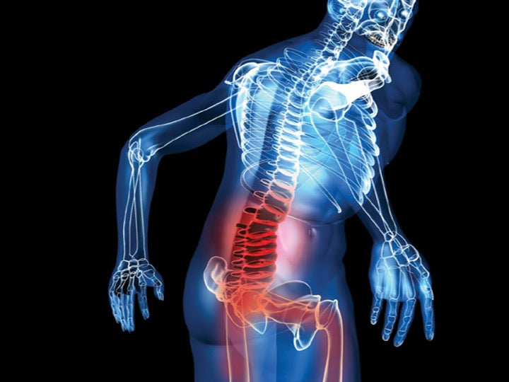 Lumbar Spinal Stenosis Online Boot Camp Program Course (Public)